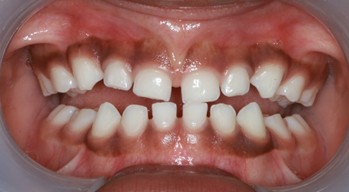 Comparison of the level of the upper anterior gumline between initial and 23-month follow-up pictures: a) initial intraoral picture; b) 23 months later