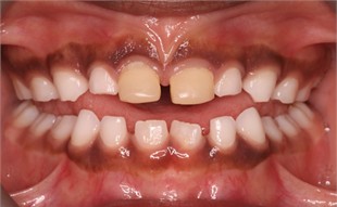 Comparison of the level of the upper anterior gumline between initial and 23-month follow-up pictures: a) initial intraoral picture; b) 23 months later