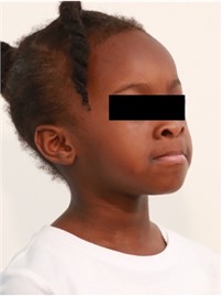 Sibling 1’s initial facial pictures
