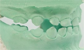 Laboratory procedure: a) the working models mounted on the articulator; b)-c) after building the direct tracks with modelling wax; d)-e) duplication and cast model; f) mock-up acetate trays made on duplicated model