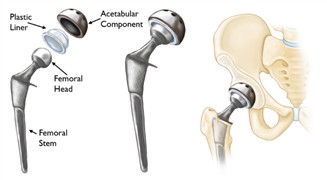 Schematic representation of a) hip and b) knee joint replacement [1, 2]