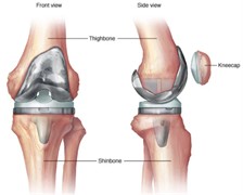 Schematic representation of a) hip and b) knee joint replacement [1, 2]