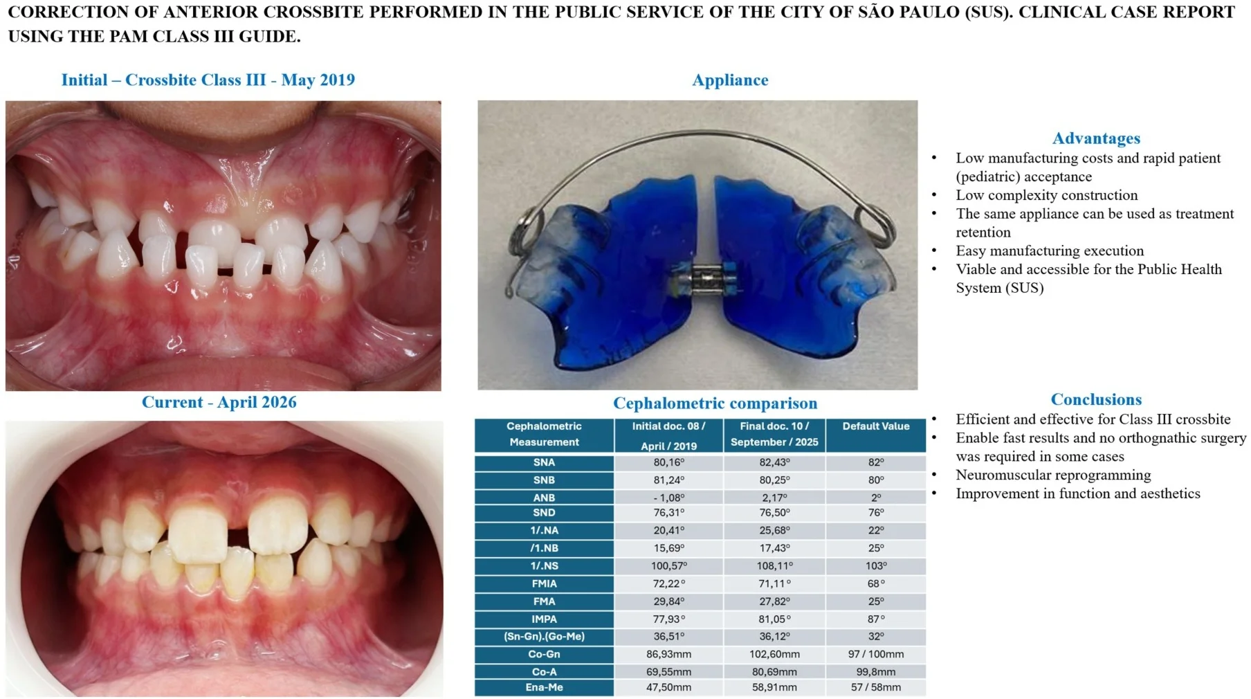 Correction of anterior crossbite performed in the public service of the city of São Paulo (SUS). Clinical case report using the pam class III guide