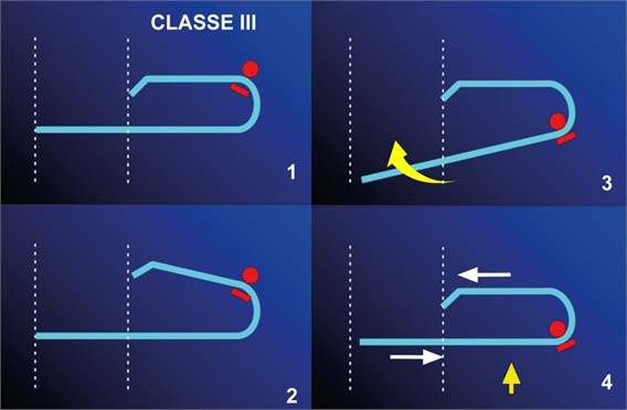 Activations of the PAM III arch: Open the upper portion by 2 mm and close the lower portion, bringing the arch to parallelism