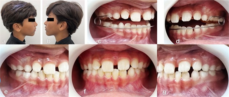 Extraoral and Intraoral photograph (April, 01, 2026): a) lateral right side extraoral photograph; b) lateral left side extraoral photograph; c) intraoral right side photograph with the appliance; d) intraoral left side photograph with the appliance; e) intraoral photograph of the right side; f) frontal intraoral photograph; g) intraoral photograph of the left side