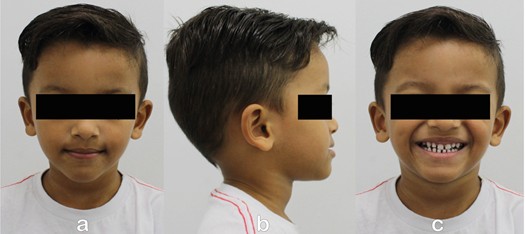GUIA PAM III Appliance: a) Frontal extraoral photograph; b) lateral extraoral photograph; c) extraoral frontal photograph of a smiling face; d) intraoral photograph of the right side; e) frontal intraoral photograph; f) intraoral photograph of the left side; g) panoramic radiograph; h) lateral cephalometric radiograph; i) occlusal view of the appliance with central expansion screw