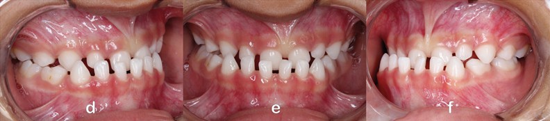 GUIA PAM III Appliance: a) Frontal extraoral photograph; b) lateral extraoral photograph; c) extraoral frontal photograph of a smiling face; d) intraoral photograph of the right side; e) frontal intraoral photograph; f) intraoral photograph of the left side; g) panoramic radiograph; h) lateral cephalometric radiograph; i) occlusal view of the appliance with central expansion screw