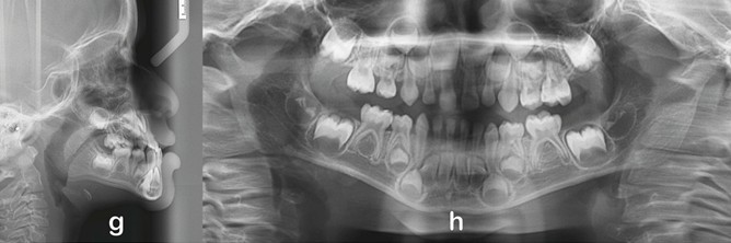 GUIA PAM III Appliance: a) Frontal extraoral photograph; b) lateral extraoral photograph; c) extraoral frontal photograph of a smiling face; d) intraoral photograph of the right side; e) frontal intraoral photograph; f) intraoral photograph of the left side; g) panoramic radiograph; h) lateral cephalometric radiograph; i) occlusal view of the appliance with central expansion screw