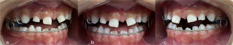 Intraoral photograph with appliance (April, 23, 2021): a) intraoral photograph of the right side; b) frontal intraoral photograph; c) intraoral photograph of the left side