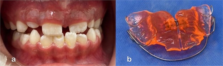 GUIA PAM III appliance: a) intraoral photograph front view; b) photograph of the appliance with the addition of a doble cantilever spring in the region of tooth 21