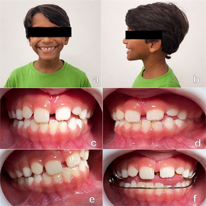 Extraoral and Intraoral photograph (April, 17, 2025): a) frontal extraoral photograph; b) lateral extraoral photograph; c) frontal intraoral photograph; d) intraoral photograph of the left side; e) intraoral photograph of the right side; f) intraoral photograph with the appliance in place