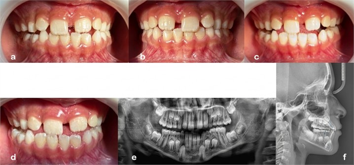 Functional intraoral photographs with mandibular movements: a) intraoral photograph with left lateral mandibular movement; b) intraoral photograph in habitual occlusion; c) intraoral photograph with right lateral mandibular movement; d) intraoral photograph with protrusive movement; e) panoramic radiograph; f) lateral cephalometric radiograph